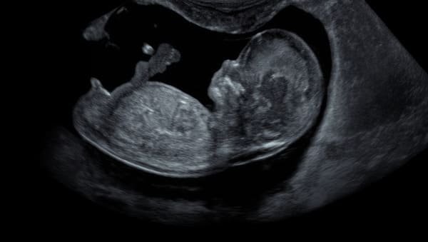 bourgeon-vers-haut-mais-fille-echographie-de-datation